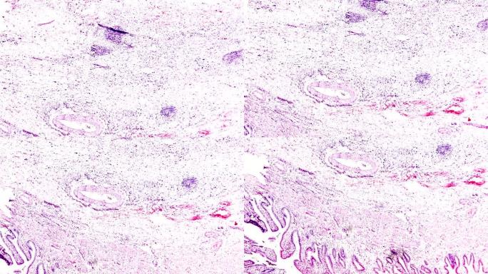 显微镜下的慢性胆囊炎人体病理样本