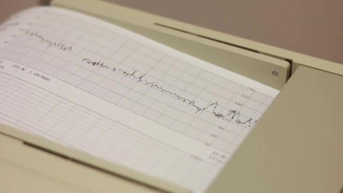 心电图装置打印一张带有分析结果的纸