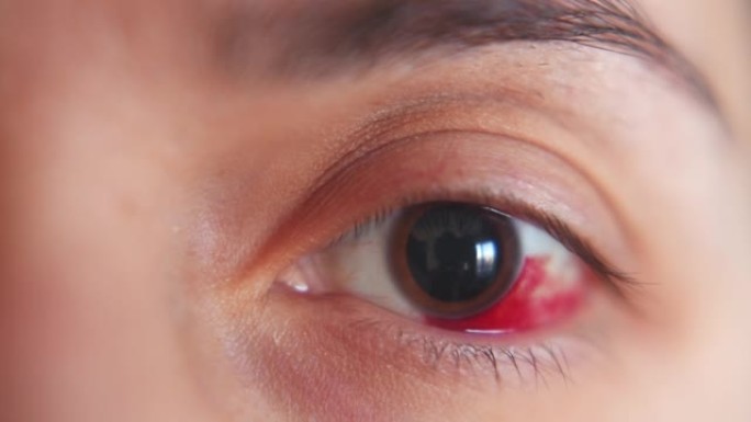 一个女孩的眼睛出血。角膜磨损。宏观。