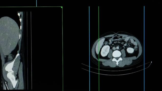 整个腹部的ct扫描或计算机断层扫描