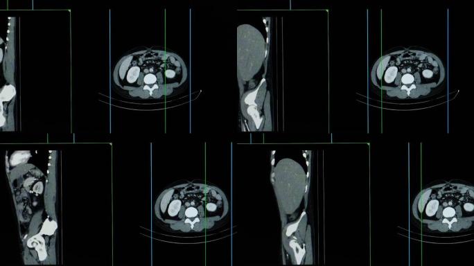 整个腹部的ct扫描或计算机断层扫描
