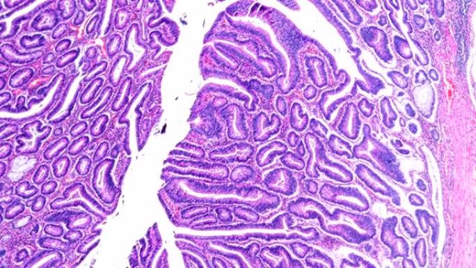 显微镜下不同区域的大肠癌 (不同管状腺癌)