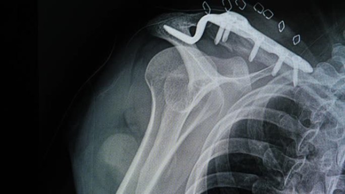 金属板和螺钉固定后锁骨骨折患者的x光片