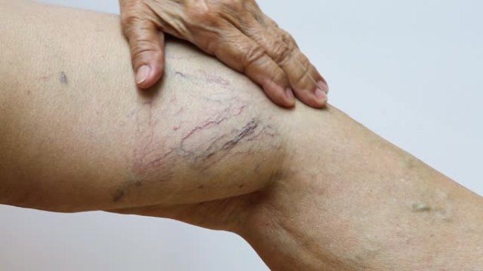 白色背景老年女性腿部静脉曲张，特写和宏观拍摄，亚洲身体皮肤部分，医疗保健概念