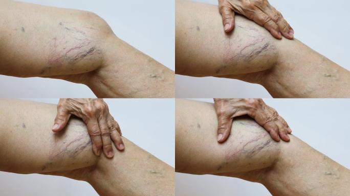 白色背景老年女性腿部静脉曲张，特写和宏观拍摄，亚洲身体皮肤部分，医疗保健概念