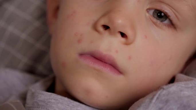 一个患有水痘的小悲伤生病男孩的特写肖像。