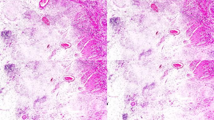 肠道人体病理标本显微镜下伤寒发热