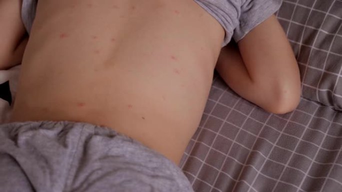 一个患有水痘和红疹的小男孩躺在床上。