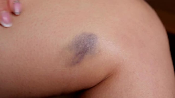 一个女人的特写应用治疗软膏在她的腿上的一个大血肿