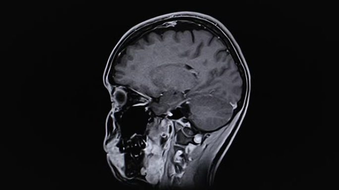 MRI脑部扫描，脑部磁共振成像。时间流逝