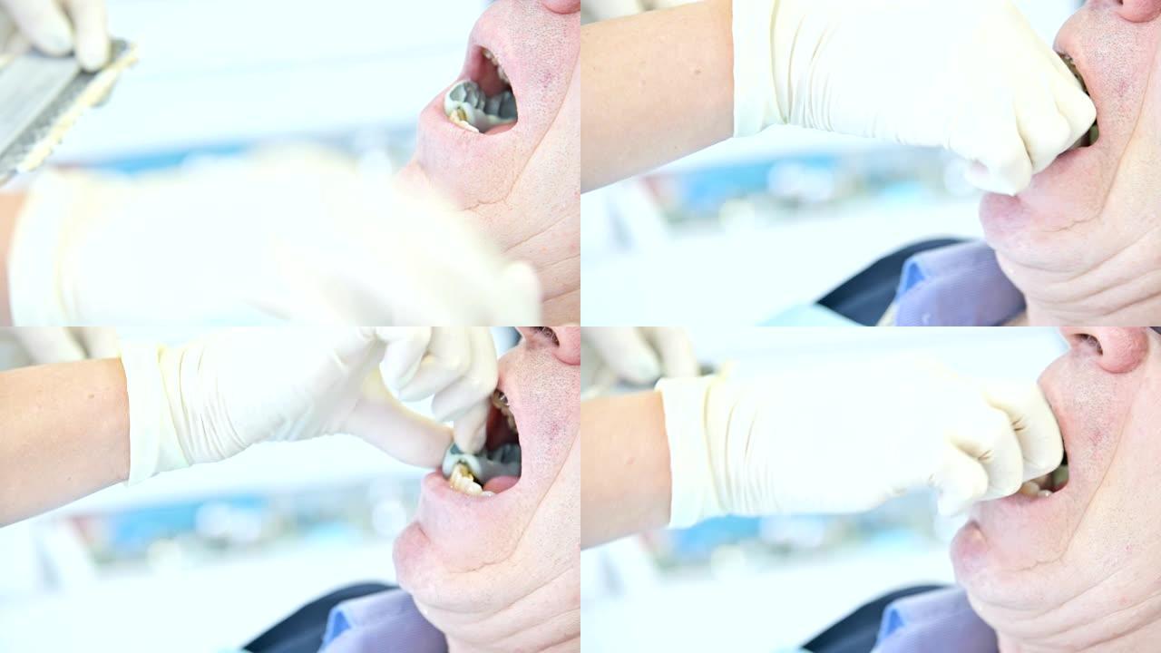 口腔科医生的特写镜头从他的嘴里移除了患者老化颜色的聚合物形式，以创建假体。4k牙科