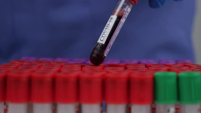 近距离研究人员在试管中保存血液以检查新型冠状病毒肺炎