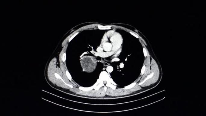 胸部大肿瘤的ct扫描。