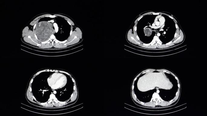 胸部大肿瘤的ct扫描。