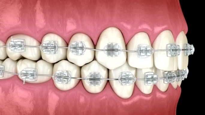 牙齿位置异常，矫正器清晰。医学上精确的牙科3D动画