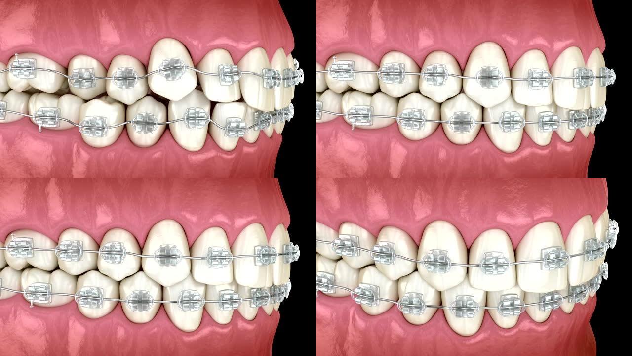 牙齿位置异常，矫正器清晰。医学上精确的牙科3D动画
