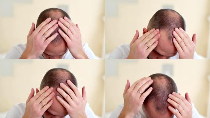 人类脱发或脱发-成年男子的手指着他的光头