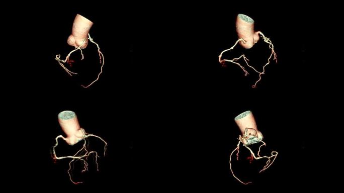 CTA冠状动脉3D渲染图像在屏幕上翻转以诊断血管冠状动脉狭窄。