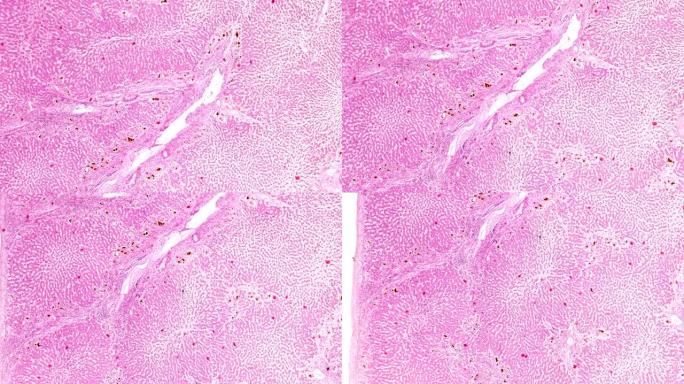 木材显微镜下急性重型肝炎
