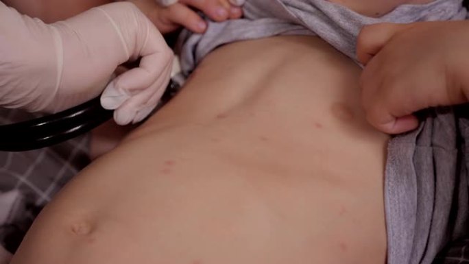 医生用听诊器检查一个患有水痘的小孩。