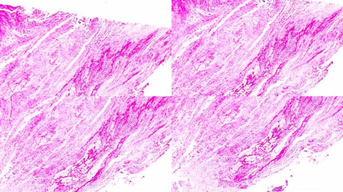 显微镜下不同区域的绒毛膜癌活检