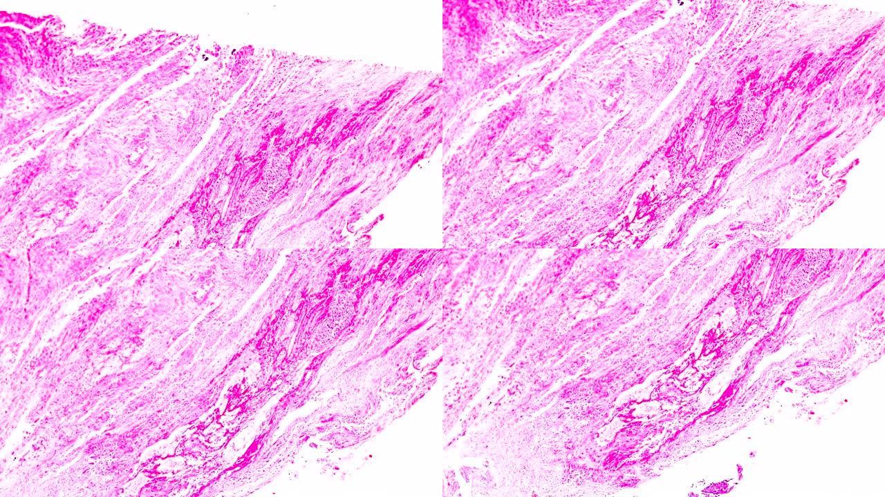 显微镜下不同区域的绒毛膜癌活检