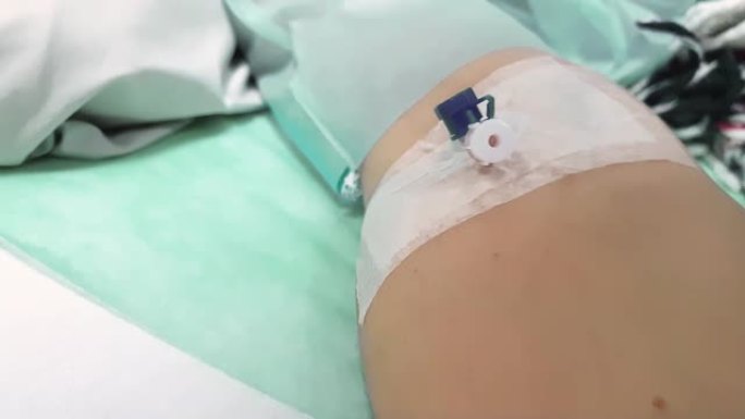 红色修指甲的女性手的特写镜头躺在医院的病床上，手里拿着导管