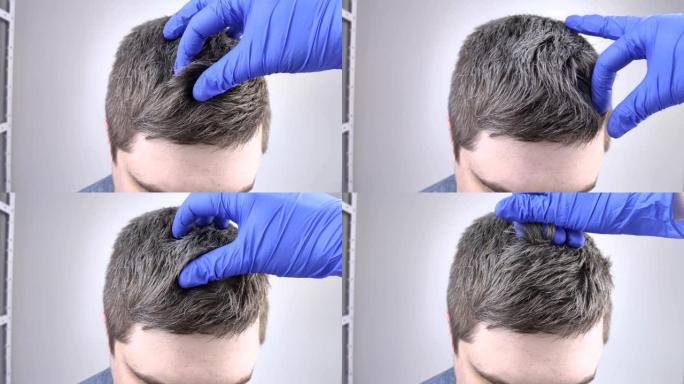 戴蓝色医用手套的trichologist医生检查了一个年轻人的白发。年轻人头发早期变灰的概念。