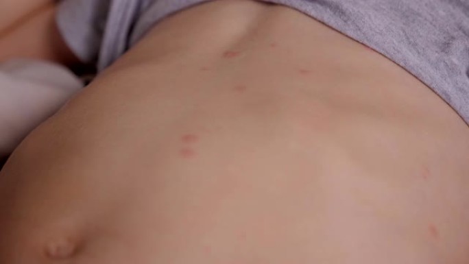 小孩子皮肤上水痘的红色丘疹和水泡的特写