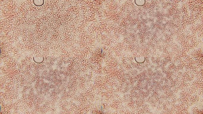 血细胞通道100x (HD 60p)。在卤素细菌学显微镜的帮助下，血小板以100倍的放大倍数形成一条