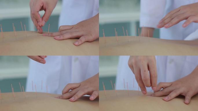 医生进行针灸治疗的手。在诊所医院接受针灸治疗的亚洲女性用细针插入面部皮肤
