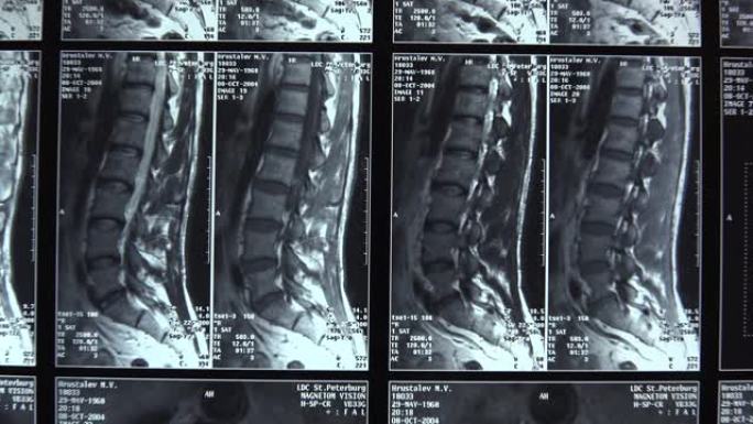 断层扫描，脊柱成像。图。4K。
