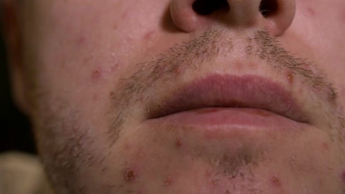 成年男性皮肤上的大皮疹或痘印特写。