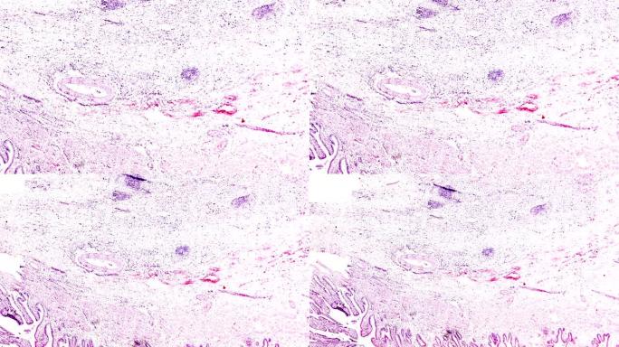 显微镜下的慢性胆囊炎人体病理样本