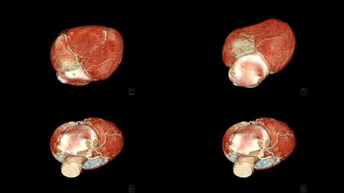 CTA冠状动脉3D渲染图像在屏幕上翻转以诊断血管冠状动脉狭窄。