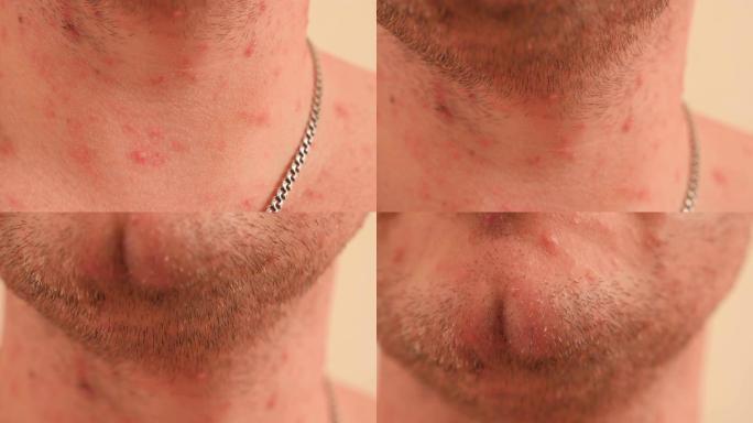 成年男性颈部和胸部的水痘特写。