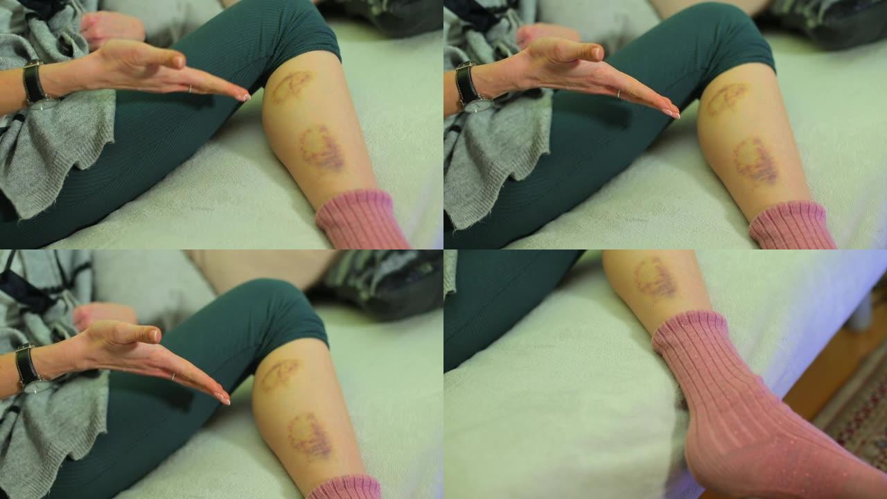 女孩腿上瘀伤的特写镜头。