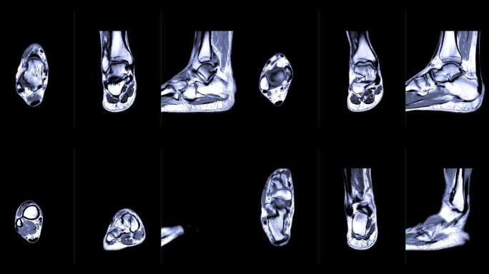 比较mri踝关节轴向，冠状和矢状位t2。