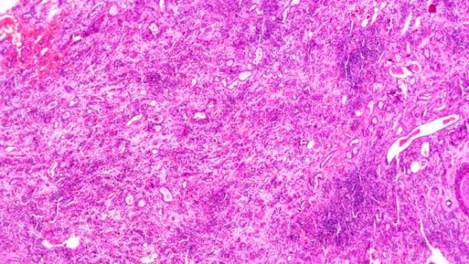 显微镜下不同区域的硬化性肾小球肾炎活检样本