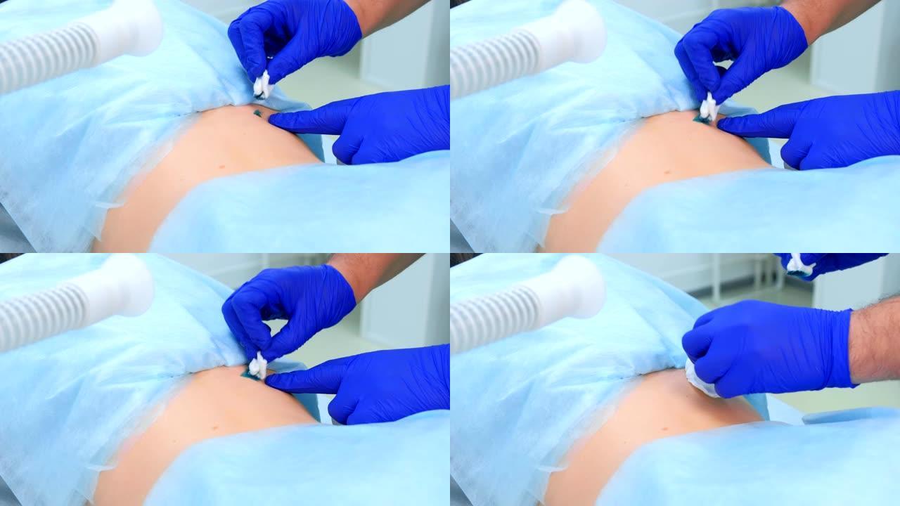 外科医生在患者背部去除的痣上应用绿色防腐剂。
