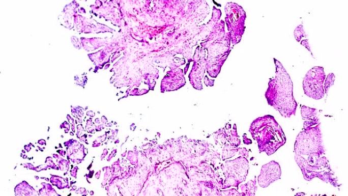 光学显微镜下卵巢囊腺瘤活检不同区域放大