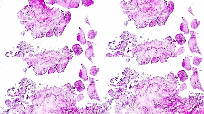 光学显微镜下卵巢囊腺瘤活检不同区域放大