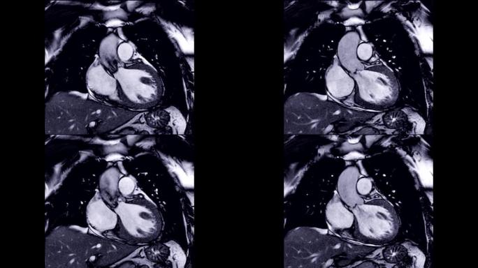 LVOT心脏MRI或心脏MRI磁共振成像。