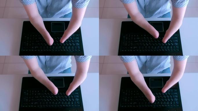 一个残肢残肢的残疾人正在笔记本电脑上打字，特写俯视图。