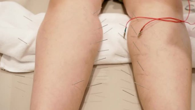 女性腿部针灸