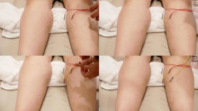 女性腿部针灸