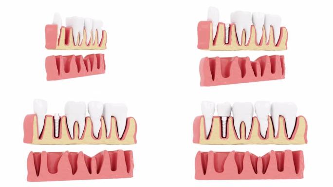 慢动作闭合断面处理种植牙。3D动画。4K