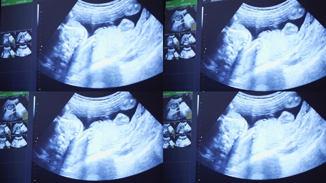 孕妇超声产检拍摄