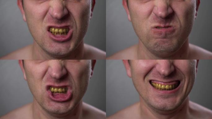 一个有黄牙的男人积极地咧嘴一笑。特写吸烟者的牙齿。