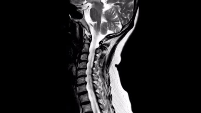 MRI颈椎矢状位T2W视图，用于诊断C3，C4脊髓压迫。